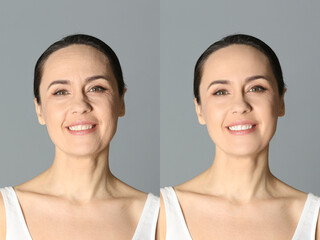 Poster - Beautiful mature woman before and after cosmetic procedure on grey background, collage. Plastic surgery