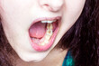 Young caucasian woman mouth with unhealthy teeth close up. Dental caries, toothache, tooth problems concept.