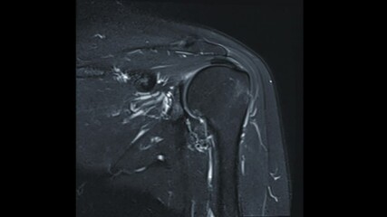 Poster - MRI Shoulder joint or Magnetic resonance imaging of Shoulder Joint Coronal T2W for diagnosis arthritis and including tears and impingement.