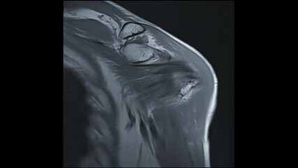 Poster - mri shoulder joint or magnetic resonance imaging of shoulder joint coronal pdw for diagnosis arthrit