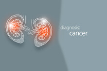 Cancer Kidney Disease Or Renal Cell Carcinomas. Malignant Kidney Tumors. Minimalistic Style Design Template With Handrawn Organ On Grey Background.