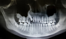 Dental X-ray With Braces. Orthopantomography, OPG X-ray DR Digital For Teen Teeth