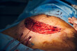 © anatoliy_gleb - Close up of open wound during tummy tuck surgery in clinic. Medical worker removing excess fat from patient belly while doing abdominal plastic surgery. Concept of abdominoplasty and cosmetic surgery.