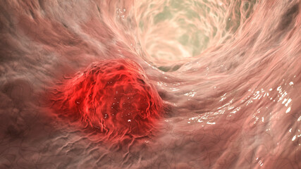 Poster - Intestinal carcinoma, colorectal cancer, bowel neoplasia, 3D illustration