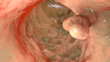 Bowel polyps, colorectal polyps, 3D illustration