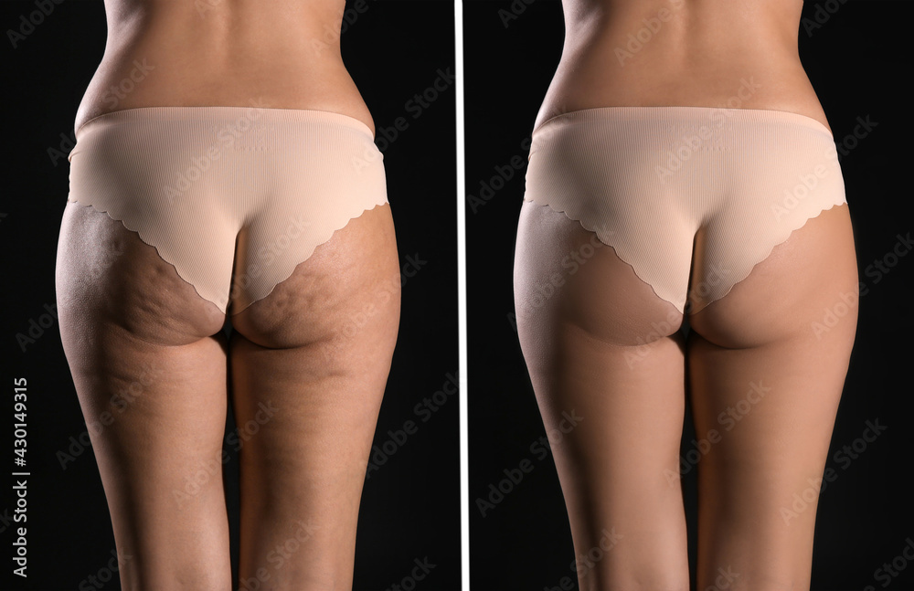 Collage with photos of woman before and after anti cellulite treatment on black background, - obrazy, fototapety, plakaty 