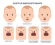 Cleft lip birth defect baby face nose Born gene drink bifid uvula roof Oral