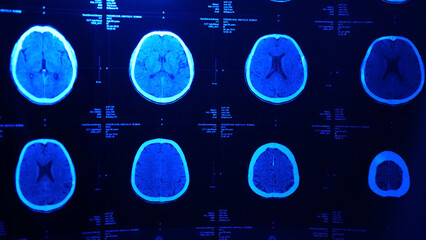 This stock photo shows a magnetic resonance imaging MRI of the brain after traumatic brain injury, showing that the brain is damaged with blue light