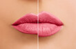 © artmim - Beautiful woman lips before and after lip filler injections close up