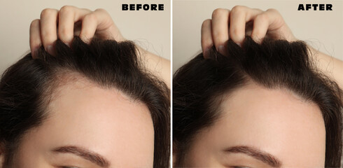 Woman suffering from baldness on beige background, closeup. Collage with photos before and after treatment