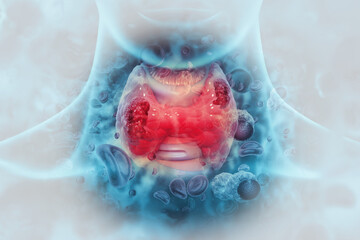 Wall Mural - Thyroid gland cancer. showing thyroid gland with tumor. 3d illustration