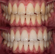 Before and after teeth bleaching