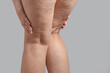 © Ольга Евдокимова - Stretch marks, cellulite and varicose veins on female legs. Copyspace
