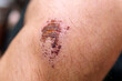 © Алексей Филатов - wound, a dried up crust change to scar on the skin. selective focus