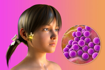 Sticker - Staphylococcus aureus bacterium as a cause of otitis media