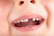 Tooth gap boy