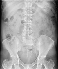 Naklejka na meble X-ray image of abdomen in supine position for doctor diagnostic