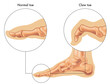 Medical illustration shows the difference between a normal toe and a claw toe, with annotations.