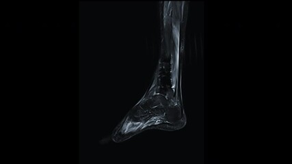 Poster - mri leg include ankle sagittal t2w view .