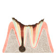 虫歯になった歯の断面（C4）
