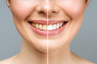 © Aleksandr Rybalko - woman teeth before and after whitening. Over white background. Dental clinic patient. Image symbolizes oral care dentistry, stomatology.