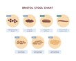 Bristol stool chart with medicine description of human excrements.