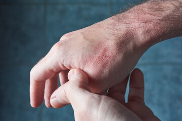 A young adult man checking his hand suffering dryness with cracked, wounded red skin.