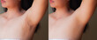 Image before and after skincare cosmetology armpits epilation treatment concept.Problem underarm chicken skin,Fox Fordyce,Black armpit in woman.