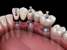 Dental Bridge Based On 3 Implants. Medically Accurate 3D Illustration Of Human Teeth And Dentures Concept