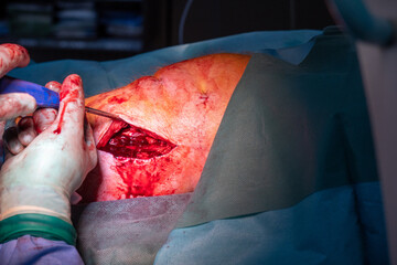 doctor performs a titanium screws explatation in operating room