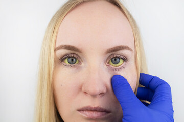 The yellow color of the woman eye. Symptom of jaundice, hepatitis or problems with the gall bladder, gastrointestinal tract, liver. Yellow eye in diseases of the liver, cirrhosis, hepatitis, bilirubin