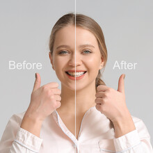 Beautiful Young Woman Before And After Smile Makeover Procedure On Grey Background