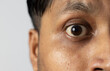 © soumen - yellow eye - symptom for health problem