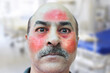 Man infected with Mucormycosis known as black fungus disease affecting people in india. Closeup of red facial swelling and blood conjunctivitis eyes, post covid Symptoms and treatment.