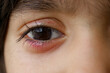 Swelled right eye of a little girl, Swelling eye of a child, Infection on eye. Allergic redness on eye.