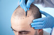 © andranik123 - Patient suffering from hair loss in consultation with a doctor. Doctor using skin marker