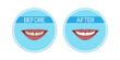Teeth whitening: before and after. Yellow teeth and white teeth. Realistic vector illustration.