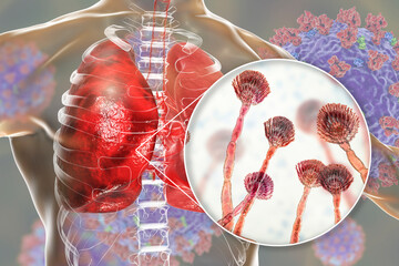 Wall Mural - Pulmonary aspergillosis, invasion of a lung tissue by mold fungi Aspergillus with closeup view of the fungi, 3D illustration