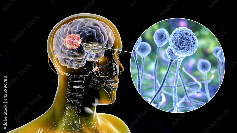 Brain Mucormycosis A Brain Lesion Caused By Fungi Mucor Also Known As brain-mucormycosis-a-brain-lesion-caused-by-fungi-mucor-also-known-as