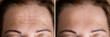 Age Anti Forehead Wrinkles Treatment Before