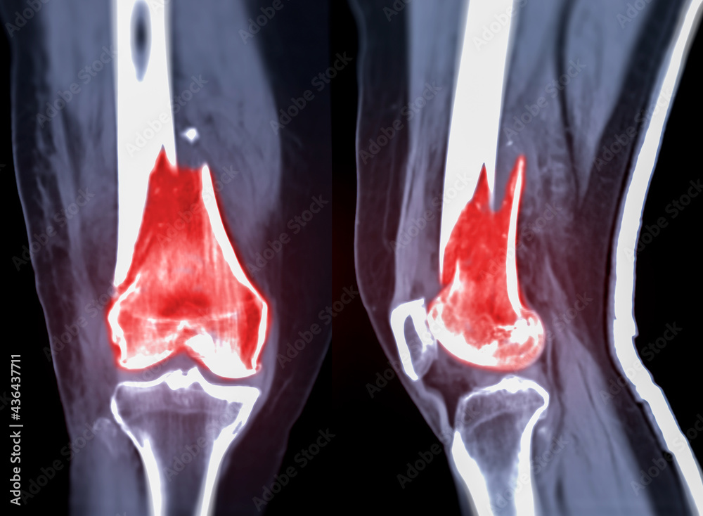 CT knee joint Coronal and Sagittal view isolated on black background ...