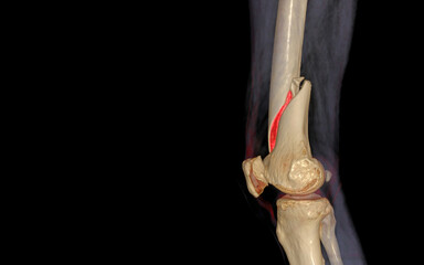 Poster - CT knee 3D rendering image Lateral view isolated on black background showing fracture Femur bone.