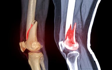 Poster - CT knee joint 3D rendering image lateral view and Sagittal view isolated on black background showing fracture Femur bone.