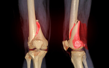 Poster - CT knee 3D rendering image AP and Lateral view isolated on black background showing fracture Femur bone.