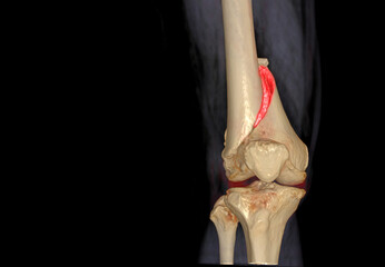 Poster - CT knee 3D rendering image AP view isolated on black background showing fracture Femur bone.
