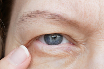 middle-aged woman does corrective eye makeup to correct the drooping eyelid. Ptosis is a drooping of the upper eyelid, lazy eye. Cosmetology and facial concept