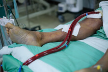 Patient's Leg With Extracorporeal Membrane Oxygenation Line (ECMO) On Bed At Critical Care Unit (CCU)