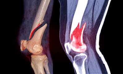 Poster - CT knee joint 3D rendering image lateral view and Sagittal view isolated on black background showing fracture Femur bone.