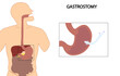 Gastrostomy illustration. Enteral nutrition feeding by gastrostomy tube. 