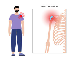 Wall Mural - Bursitis inflammation concept